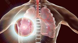 这3种肩痛或是肺癌的信号，建议了解下