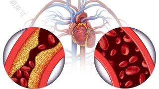 全身血管有3个部位易出现堵塞，没有及时抢救可威胁生命