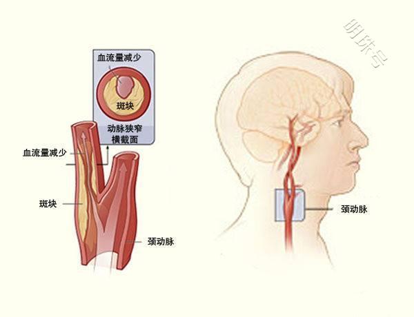 颈动脉有斑块，会出现什么症状？应该如何治疗？医生为你揭晓答案