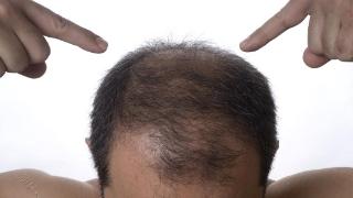 无论男性还是女性，脱发都可能对自信心和生活质量产生负面影响