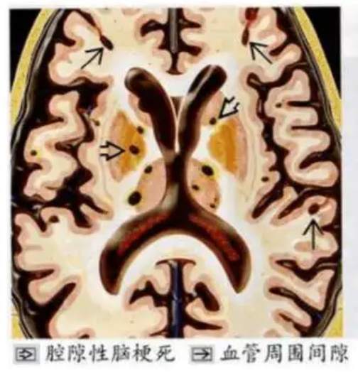 “阳康”市民体检意外发现“腔梗”，医生：与新冠无关联