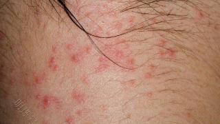 湿疹的临床表现有哪些？湿疹怎么办好？