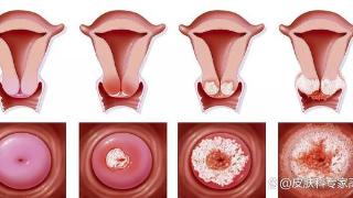 HPV16、18型，毒力强，感染就会癌变？