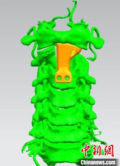 浙江多学科专家成功切除颈椎脊索瘤 为患者植入3D打印假体