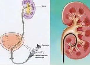 无创伤治结石——输尿管软镜治疗泌尿系结石
