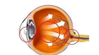 眼球胀痛+头疼，眼压升高怎么办？