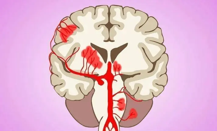 高血压者，若出现“1麻1疼1红”，很遗憾通知你：脑梗或不请自来