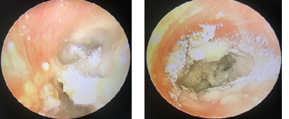 成都民生耳鼻喉专科医院：什么是真菌性外耳道炎?