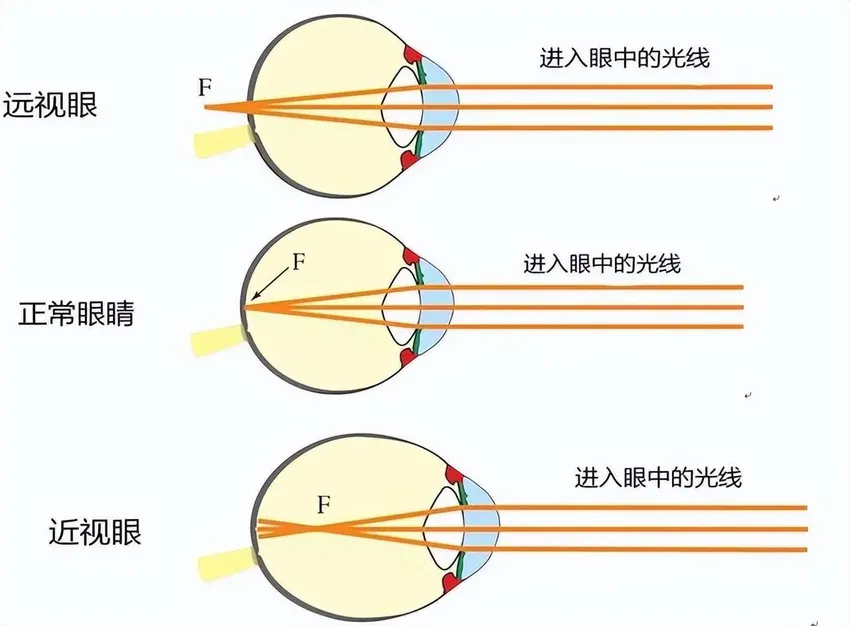 近视的人年纪大了之后，是视力逐渐改善，还是会同时得上老花眼？