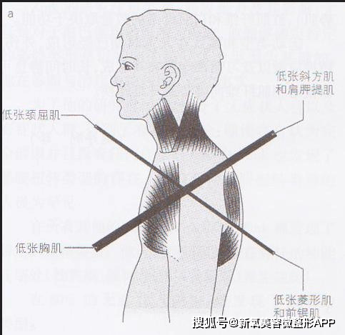 脸下垂是因为背太肥？五点起床的张柏芝给了答案？