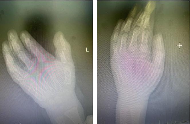 4岁小朋友手指被“夹断”，医生提醒：这些情况要特别注意
