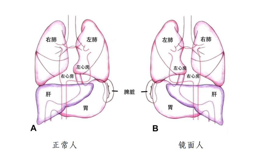 发生率百万分之一！海南一女子竟是罕见“镜面人” 手术要“反向做”