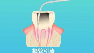 拍牙片怎么判断是否需要做根管治疗