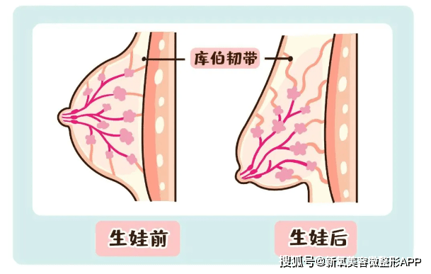 有多少人是胸外扩？不要过度容貌焦虑！