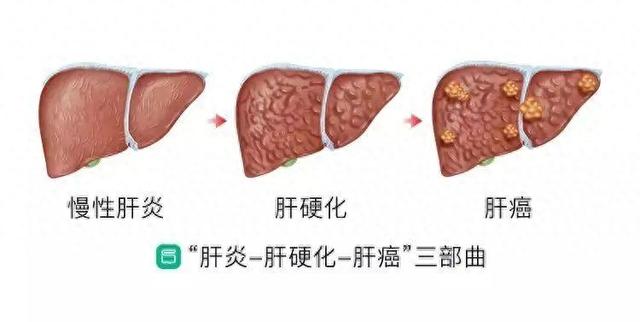 肝受损的人，牢记“2吃3不吃”，养肝排毒，肝病渐渐“远离”