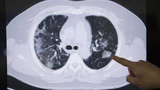 男子从不抽烟，3毫米肺结节2年后变肺癌！医生：小心两种肺结节