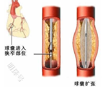 什么是血管斑块，它是怎么形成的？一文科普下