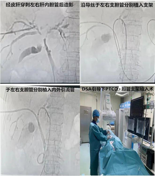 高龄胆管癌患者，也有微创手术治疗机会