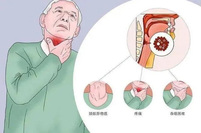 以为是慢性咽炎，去医院却查出食管癌？医生：5点区别要了解