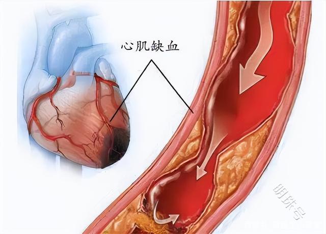 急性心肌梗死的5个原因，可能是急性心肌梗死的发生前兆