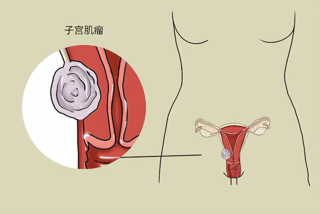 女性想要远离子宫肌瘤，需要远离这些行为