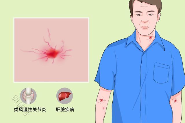 身上若有“一痒二红三痛”的情况，一定要及早做肝癌筛查，别大意