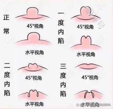 什么样的乳头算内陷？科普下