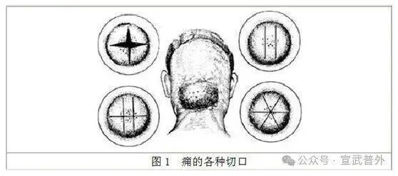 “疖子”虽小，后患无穷