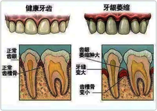 牙龈萎缩是一种怎样的体验？