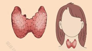 生活中的天然“散结药”，虽不值钱，常吃帮助甲状腺结节变小