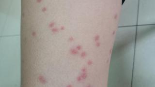 孩子身上有红点，是湿疹发作吗？