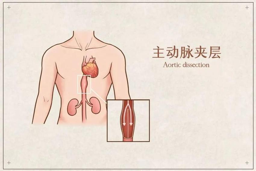 日照心脏病医院：一天成功救治2例A型主动脉夹层术