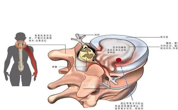 颈椎病并不可怕，找到正确的方法，完全可以和它和平共处