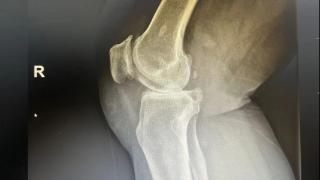 淄博世博高新医院：膝关节单髁置换术为患者点燃“膝”望