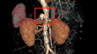 女子腹痛两个月，竟是腹主动脉夹层：国产升级“四开窗”挑战腔内治疗禁区