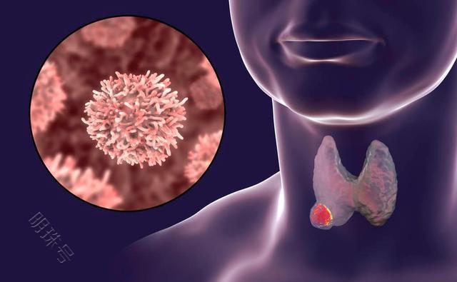 甲状腺癌的高危因素，了解下涨知识