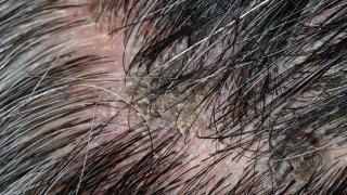 如果发现毛囊炎一定要及时进行治疗，避免疾病恶化给患者带来伤害