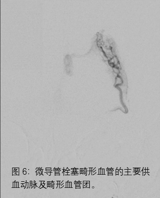 青年人脑出血，原因何在