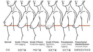 联合丽格第一医院杨大平教授：哺乳后胸部萎缩下垂该如何改善？