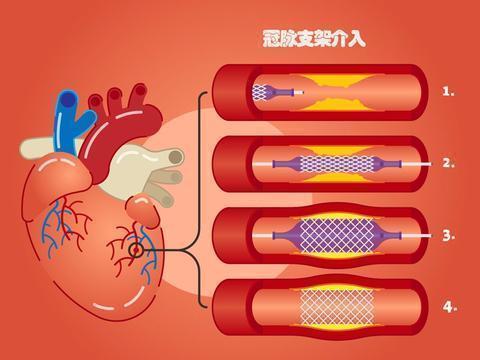 钟南山院士放置心脏支架18年，血管一直未堵过