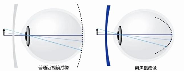 北京爱尔英智眼科医院唐琰：离焦镜真的可以延缓近视进程吗？