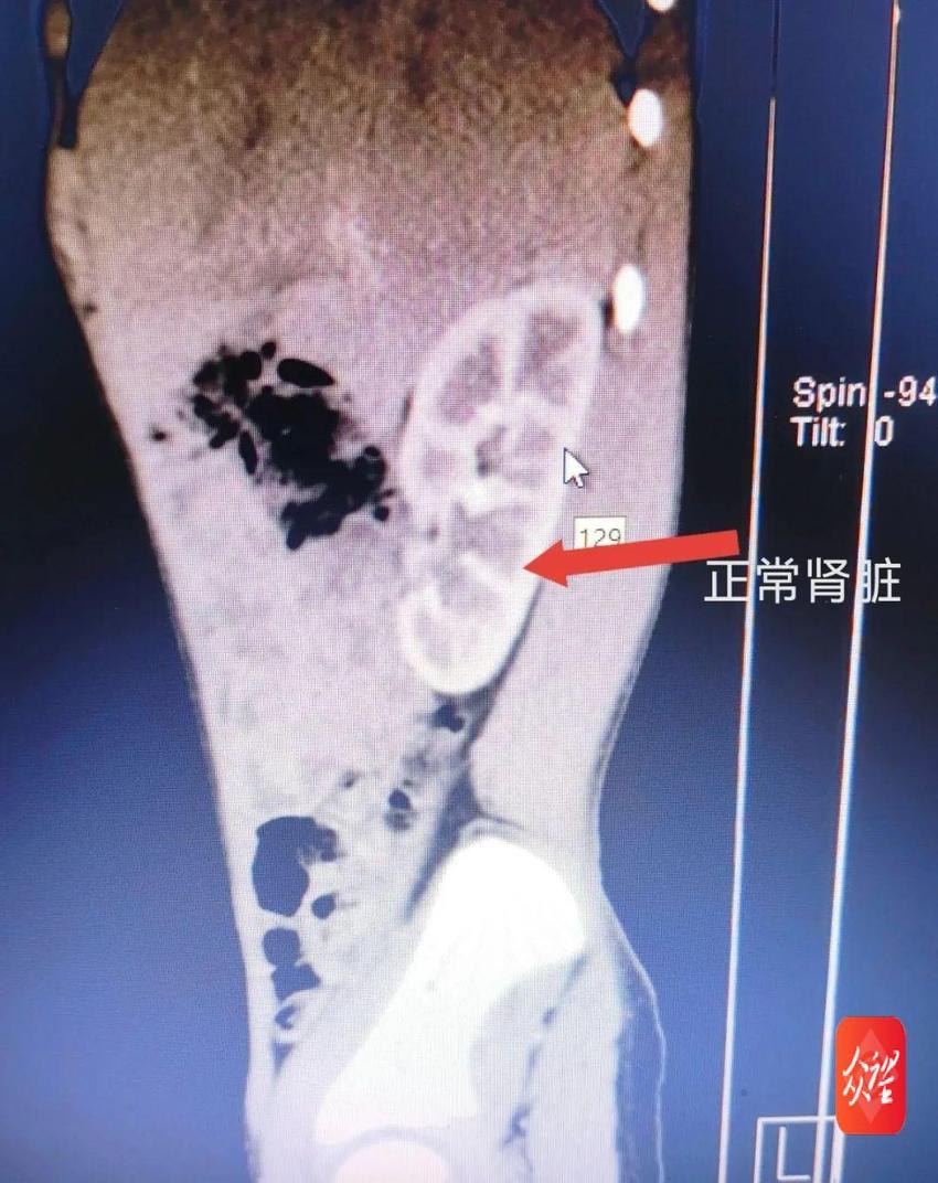 玉屏人民医院：完成首例“肾盂输尿管狭窄离断成型”术