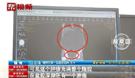 23岁女子莫名大肚去就医取出42斤肿瘤：为姐妹瘤，大肿瘤直径45厘米