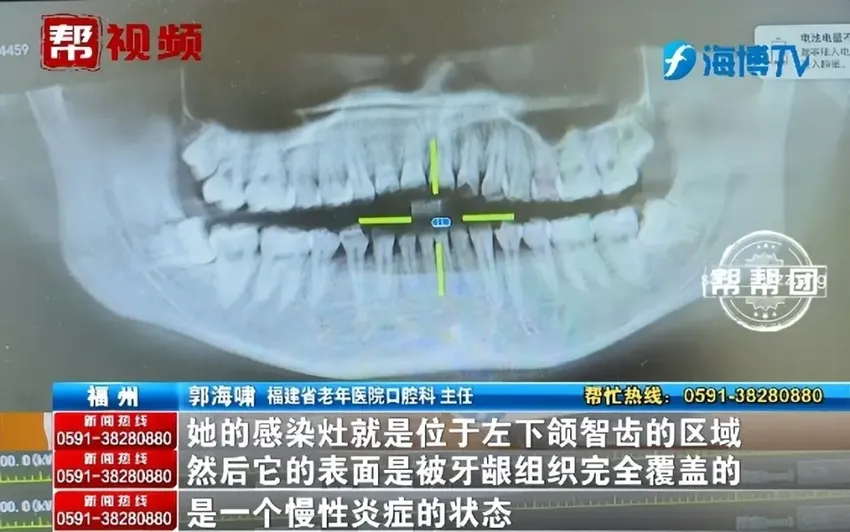 长智齿竟烂穿下颌！医生提醒：18岁以后这件事一定要做！