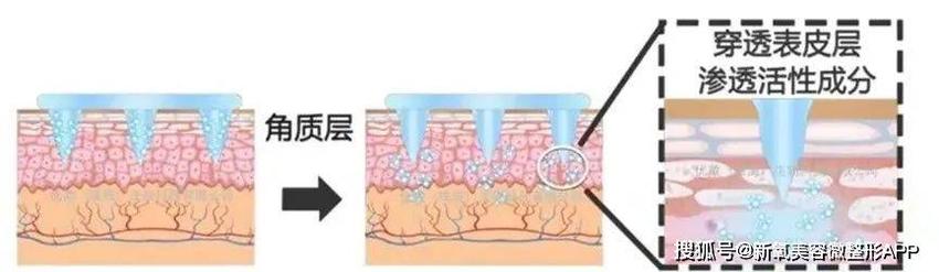 让卡戴珊三姐脸上留大坑差点毁容的痘痘，不管会要人命？