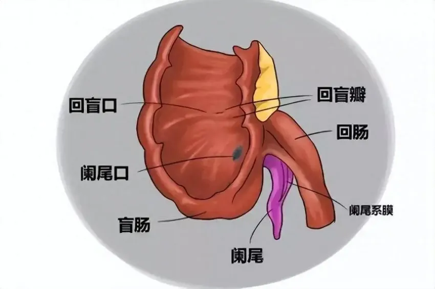 急性阑尾炎怎么回事？如何治疗？预防记住3点！