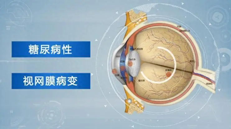 糖尿病视网膜病变怎么回事？注意这些症状，做好早期预防！