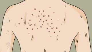 后背皮肤不光滑，长出很多“青春痘”是怎么原因？不妨看看