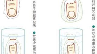 断指（肢）发生后应该这么做