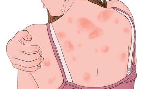 抵抗力下降引起的荨麻疹怎么治